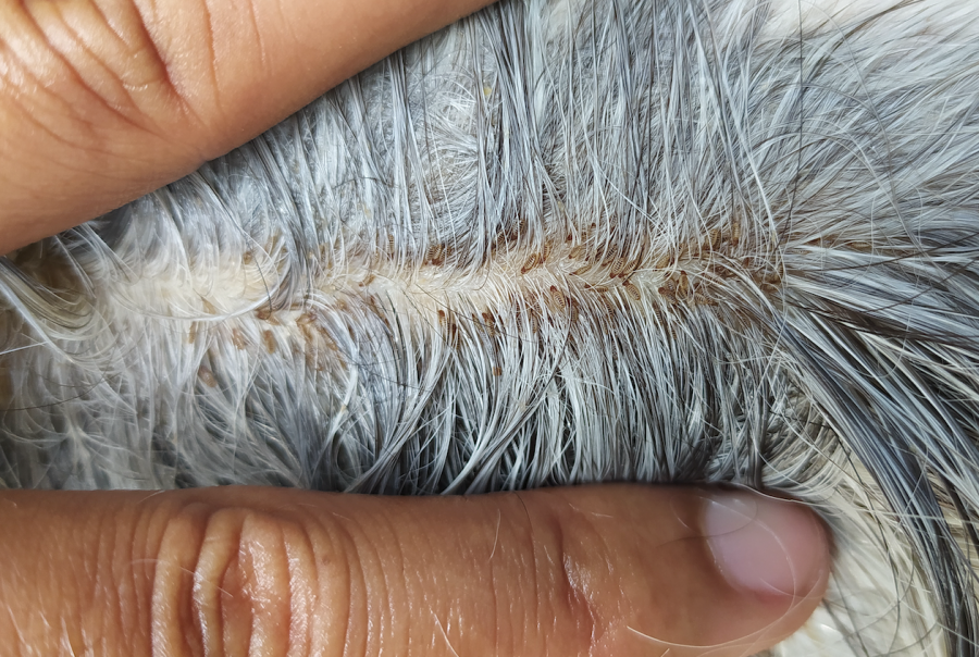 Photo shows lice crawling in a horse's coat